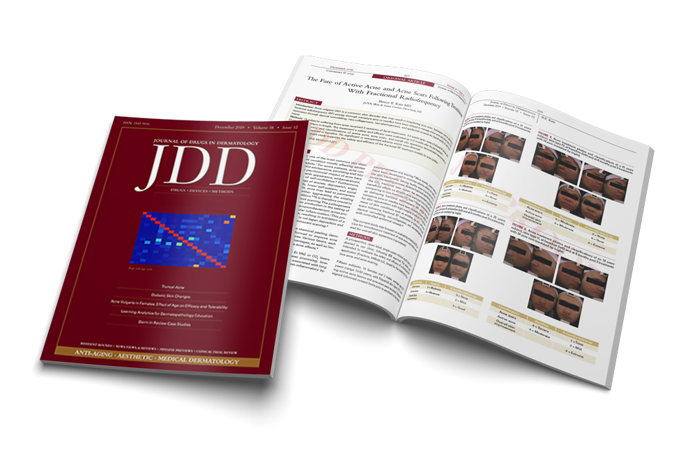 The Fate of Active Acne and Acne Scars Following Treatment With Fractional Radiofrequency