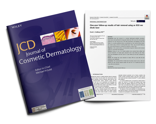 One year follow up results of hair removal using an 810 nm diode laser