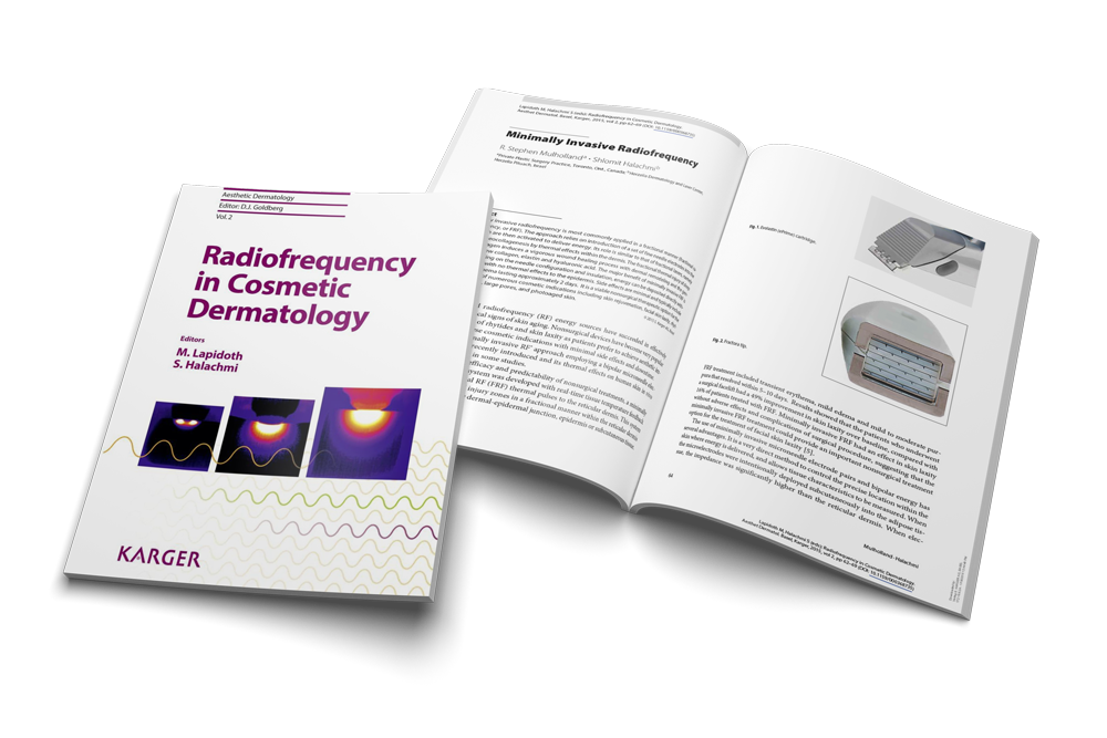 Minimally Invasive Radiofrequency