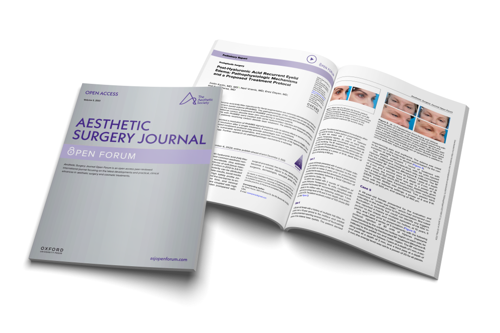 Morpheus8 as a Treatment for HA Filler Complication