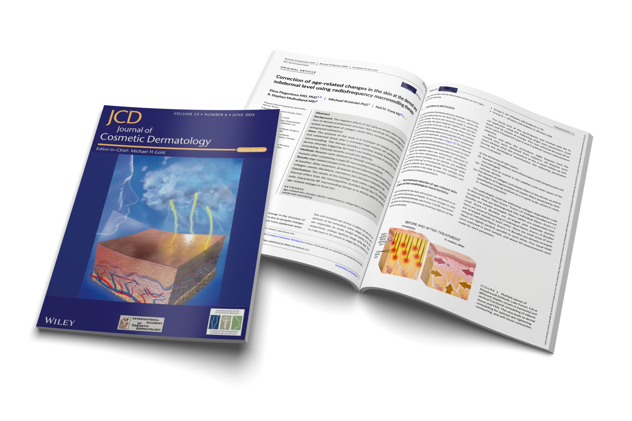 Correction of age-related changes in the skin at the dermal and subdermal level using radiofrequency macroneedling therapy