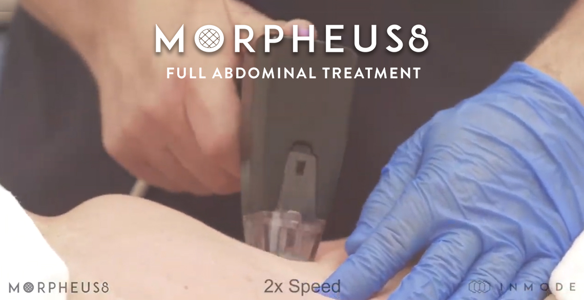 Live Demo: Abdominal Skin Tightening with Morpheus8 RF
 – Dr. Nicholas Nikolov