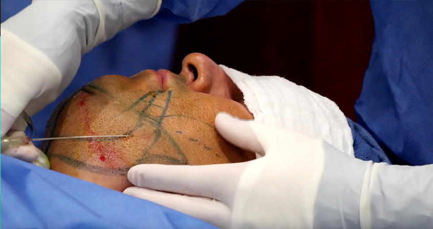 Live Demo: Neck Tightening with FaceTite and Morpheus8 RF – Dr. Christopher Chia