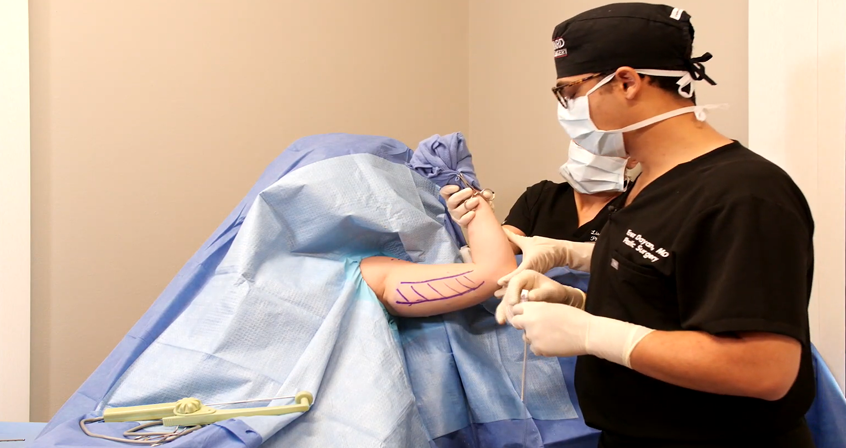 Live Demo: RF Brachioplasty with BodyTite and Morpheus8 – Dr. Erez Dayan