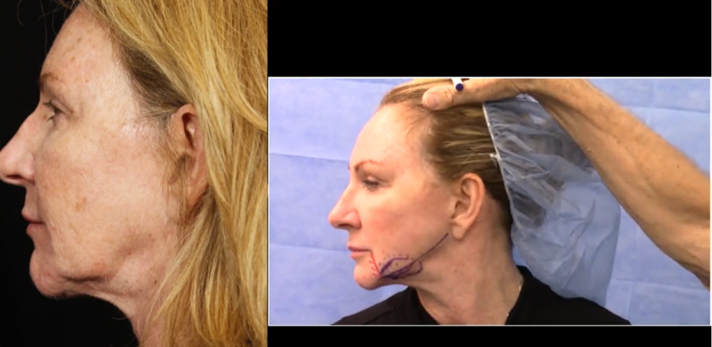 Live Demo: Jowl and Jawline Contouring with FaceTite RF - Dr. Sherrell Aston