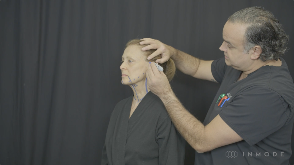 Live Demo: Morpheus8 & AccuTite, Adjunctive Procedure to Facelift - Dr. Spero Theodorou