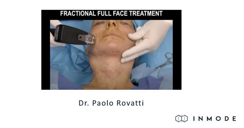 Live Demo: Morpheus8 RF for Subdermal Adipose Remodeling – Dr. Paolo Rovatti