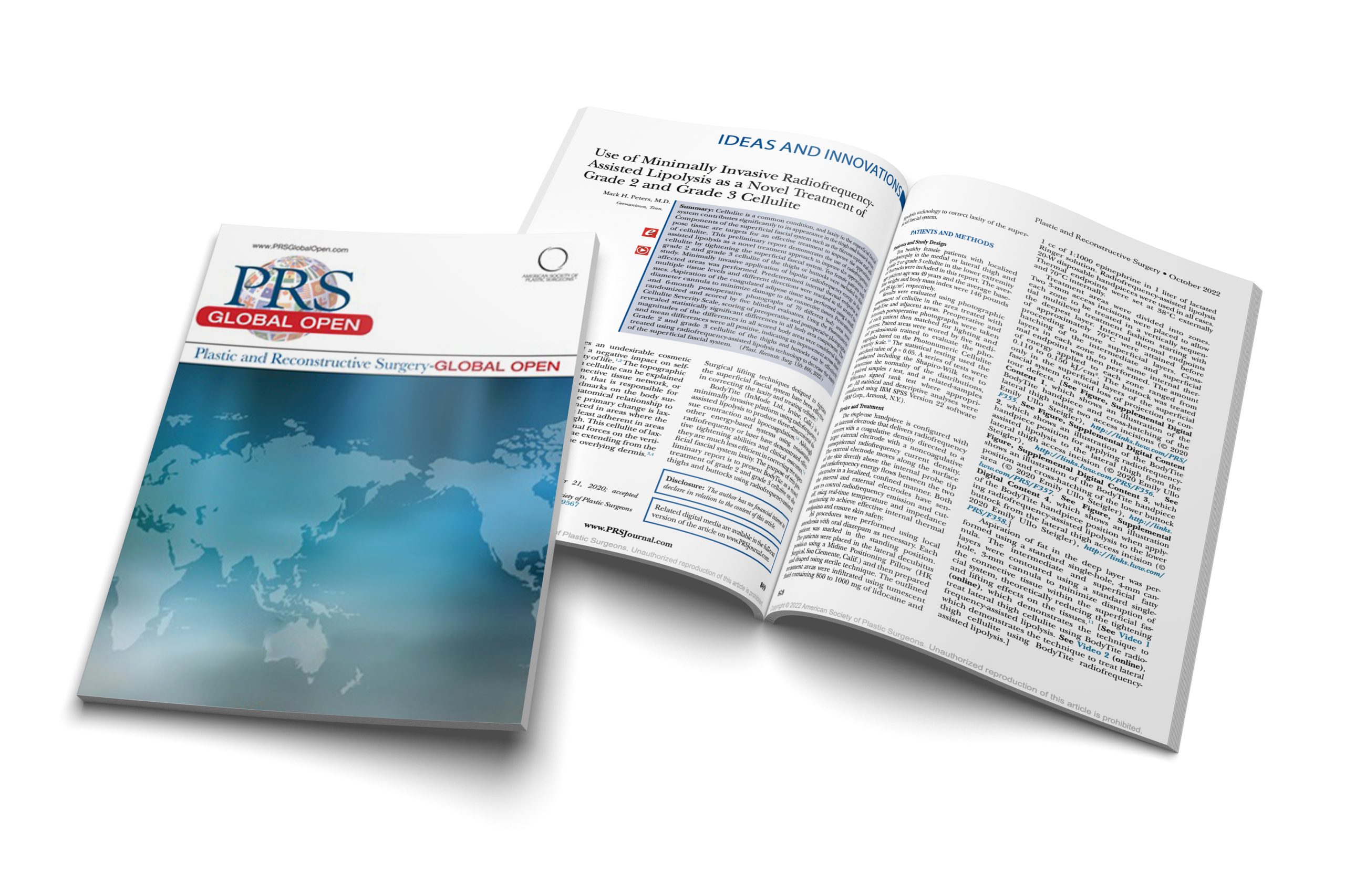 Use of Minimally Invasive Radiofrequency-Assisted Lipolysis as a Novel Treatment of Grade 2 and Grade 3 Cellulite