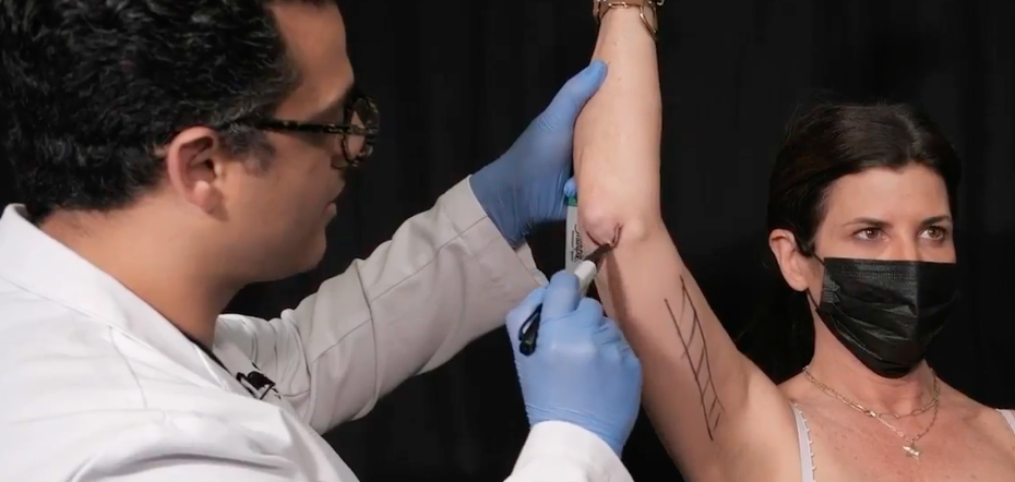 Live Demo: Skin Tightening on Arm and Knee with BodyTite + Morpheus8 – Dr. Erez Dayan