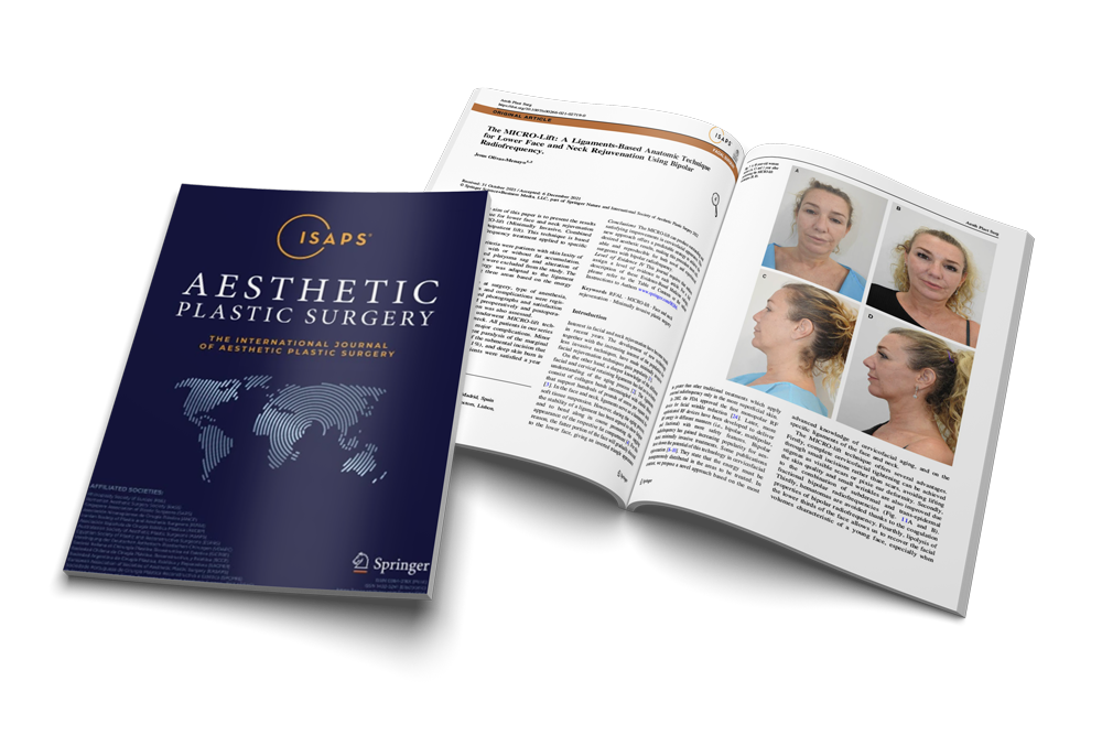 The MICRO-Lift: A Ligaments-Based Anatomic Technique for Lower Face and Neck Rejuvenation Using Bipolar Radiofrequency.