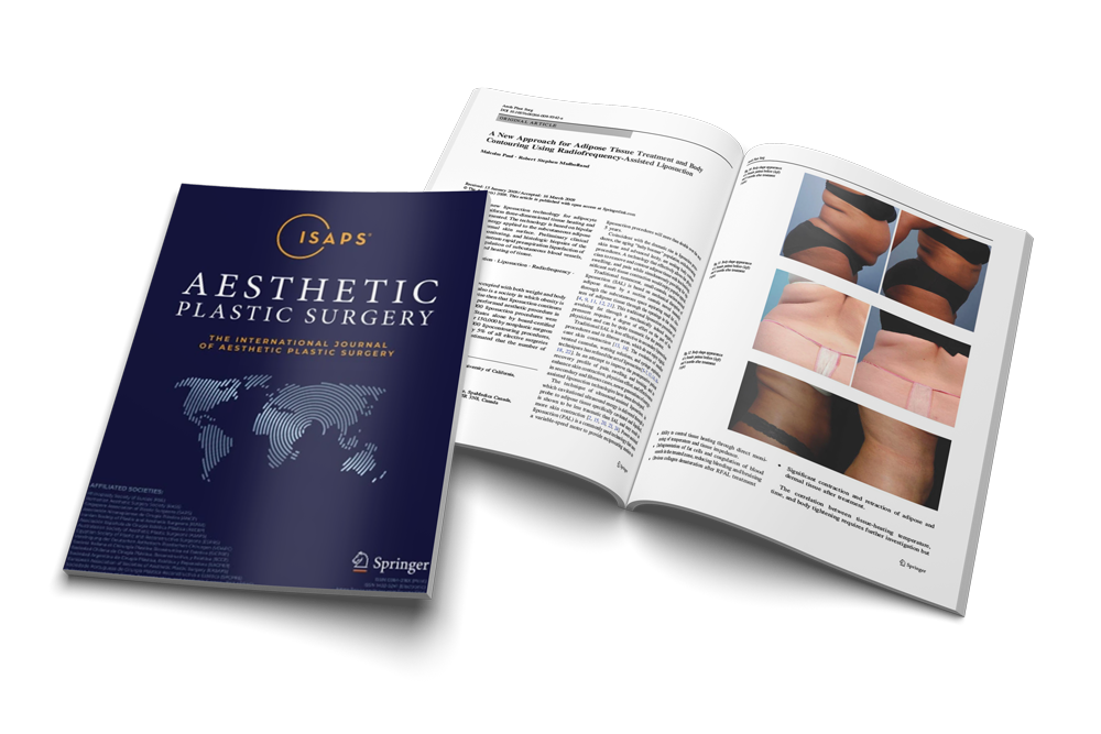 A New Approach for Adipose Tissue Treatment and Body Contouring Using Radiofrequency-Assisted Liposuction