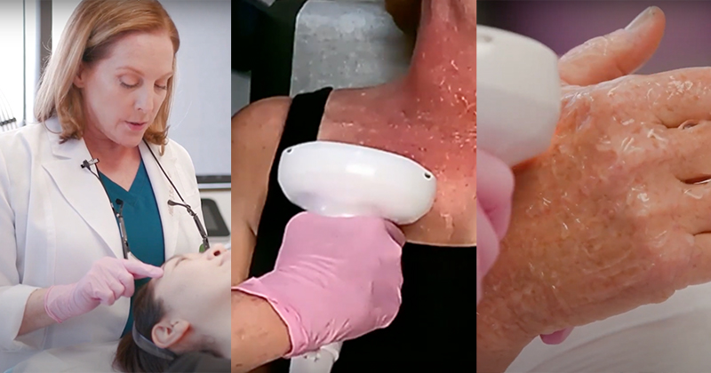 Live Demo: Lumecca IPL for Skin Pigmentation & Rosacea
 – Dr. Heather Roberts