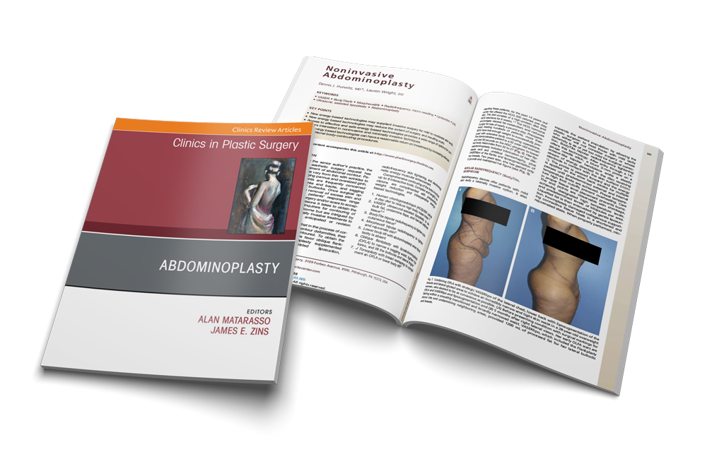 Study: BodyTite & Morpheus8 in Noninvasive Abdominoplasty