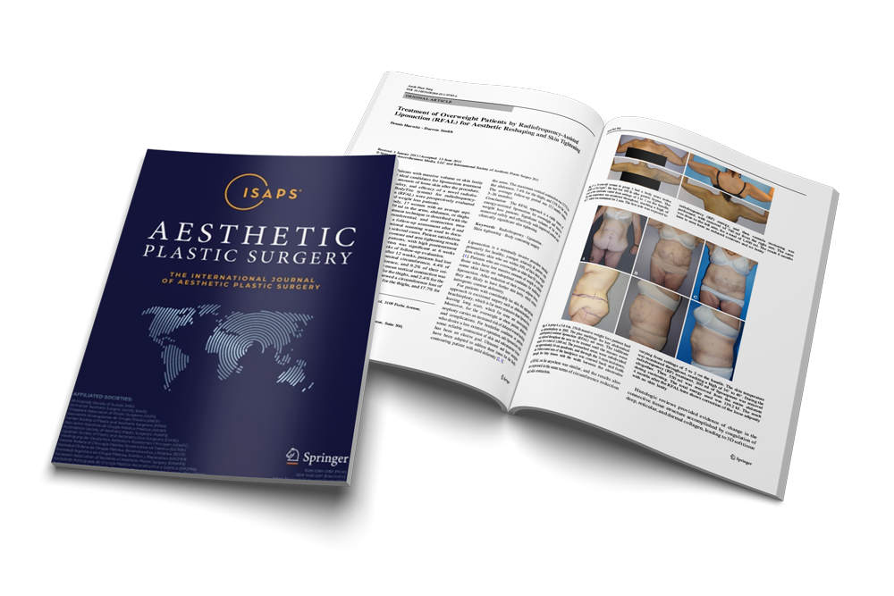 Treatment of Overweight Patients by Radiofrequency-Assisted Liposuction (RFAL) for Aesthetic Reshaping and Skin Tightening