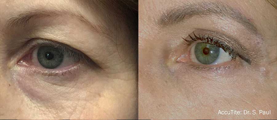 AccuTite-Before-and-After-Eyebags