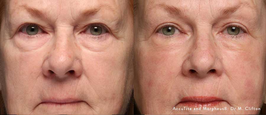 AccuTite-Before-and-After-Fine-Lines