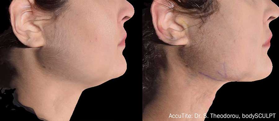 AccuTite-Before-and-After-Precision-Jaw-Contouring