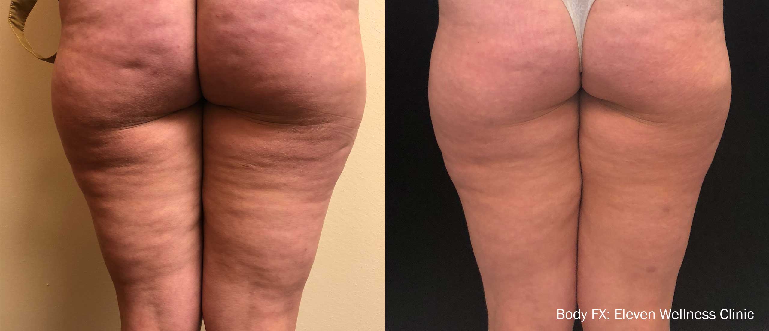 BodyFX Before and After Cellulite on Buttocks Banana Rolls