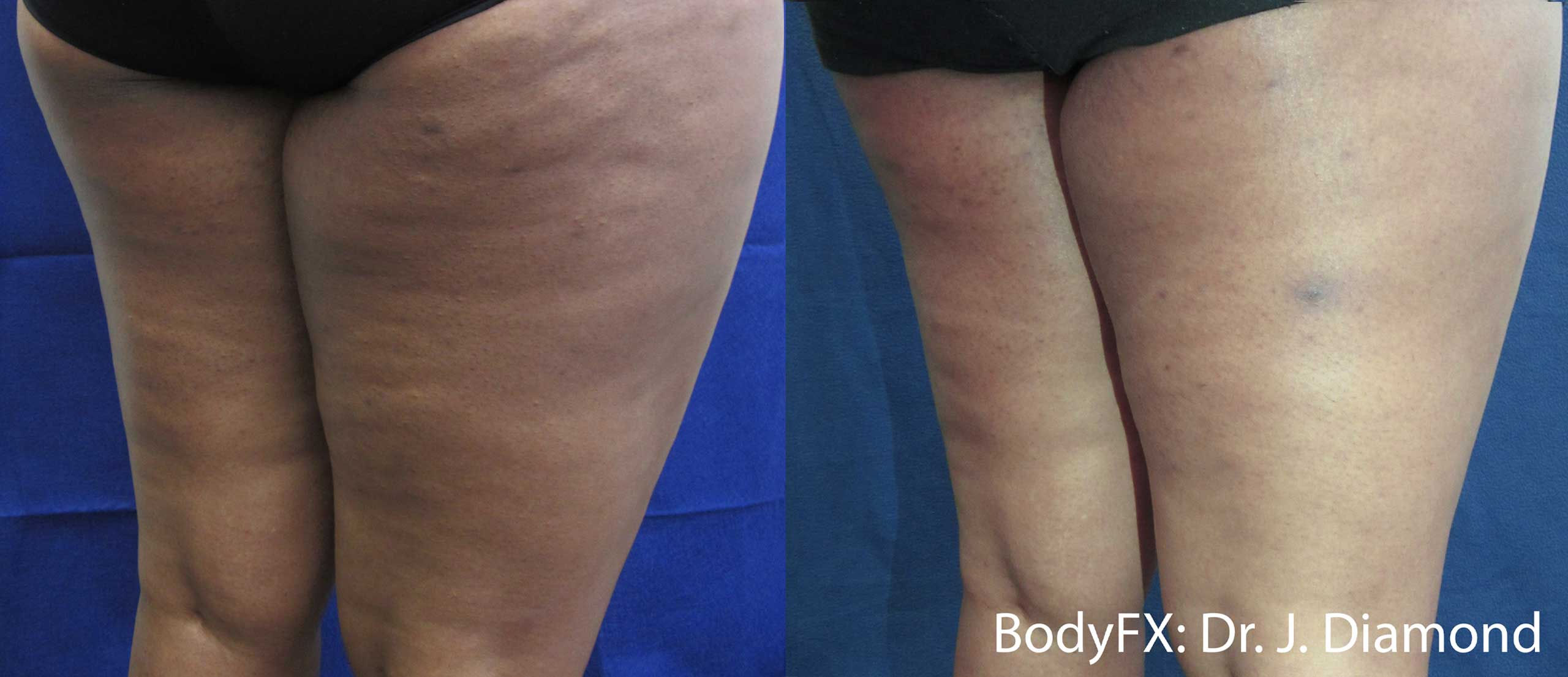 BodyFX Before and After Cellulite on Thighs
