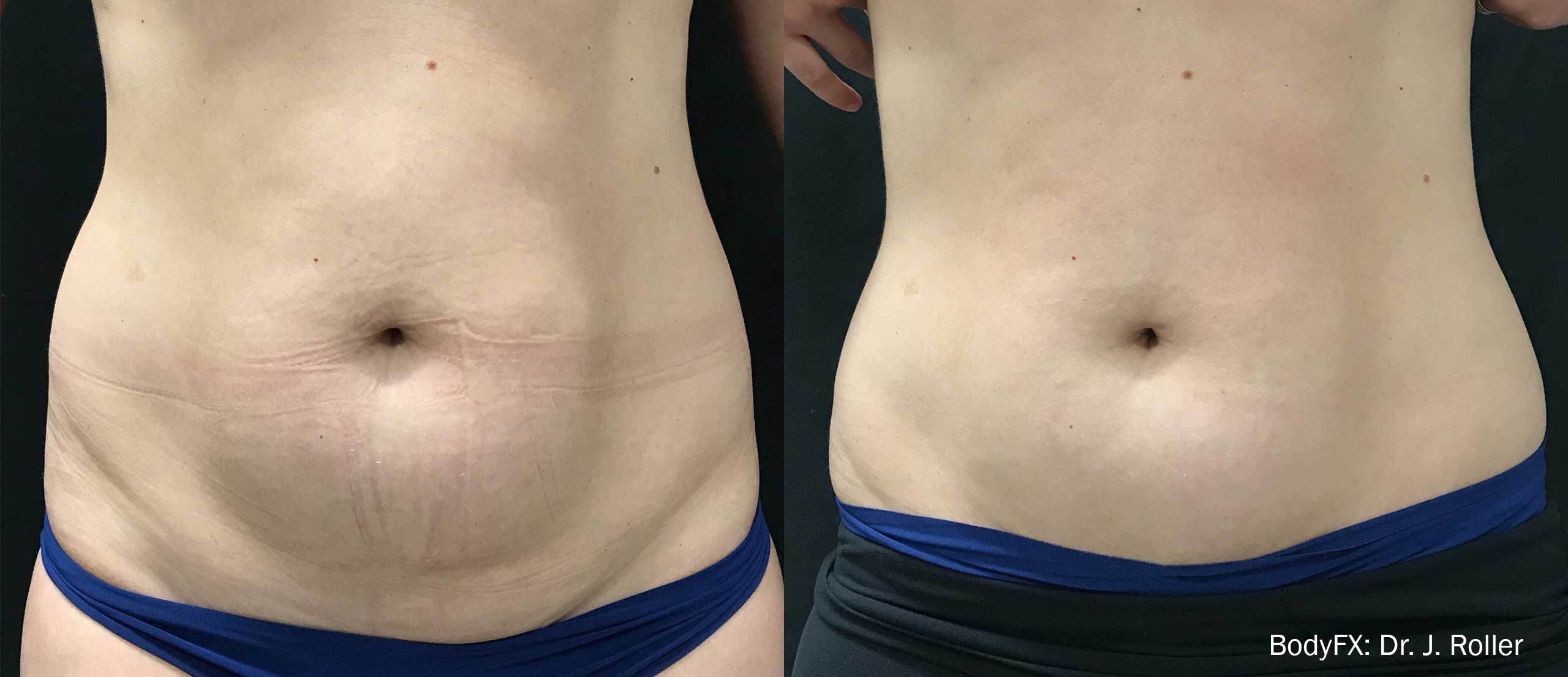 BodyFX Before and After Stomach