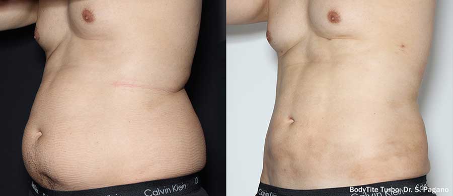 BodyTite-Before-and-After-Abdomen
