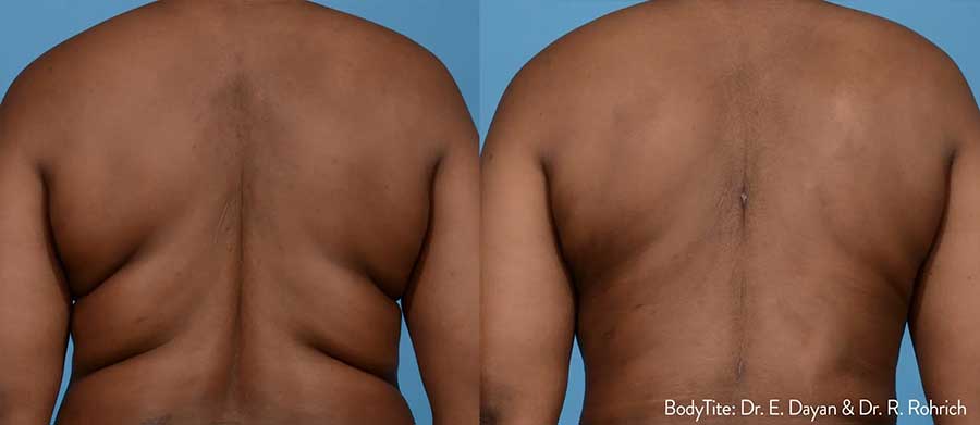 BodyTite-Before-and-After-Back