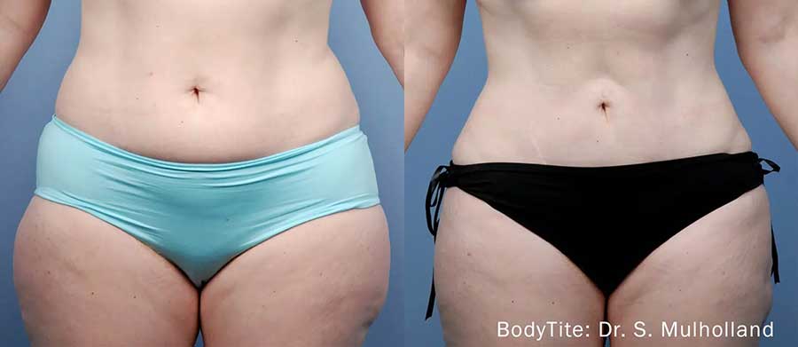 BodyTite-Before-and-After-Body-Contouring