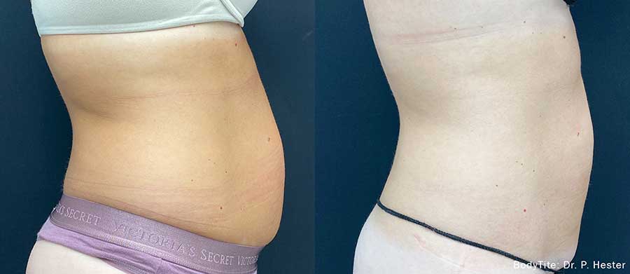 BodyTite-Before-and-After-Tummy-Tightening