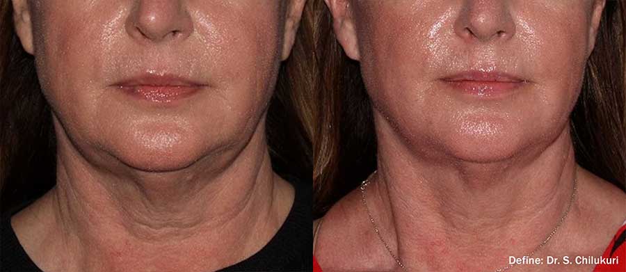 Define-Before-and-After-Jaw