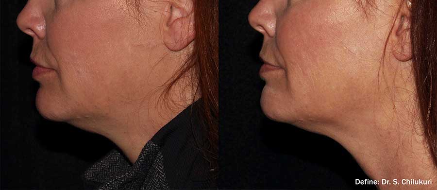 Define-Before-and-After-Neck