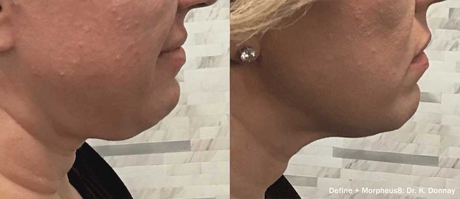 Define-Before-and-After-Submental