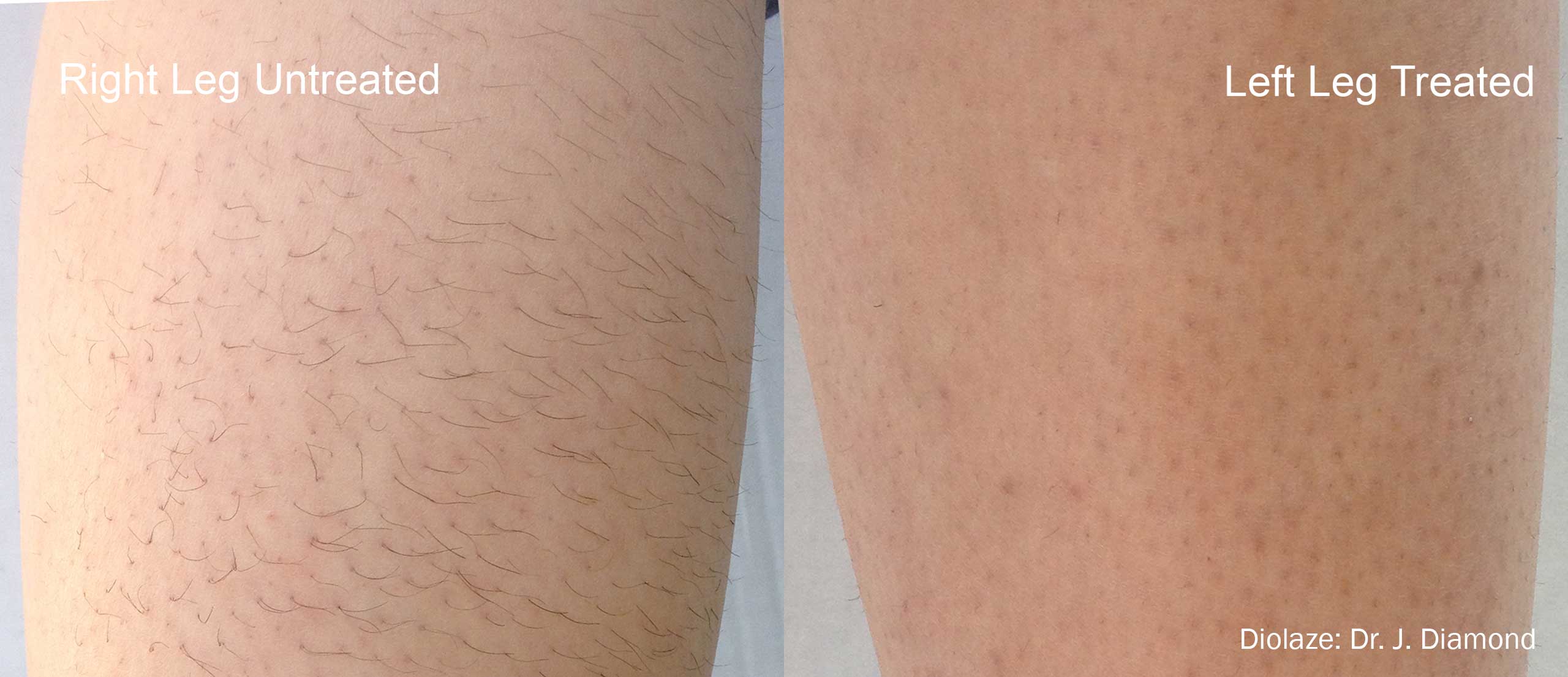 Diolaze Before and After Leg