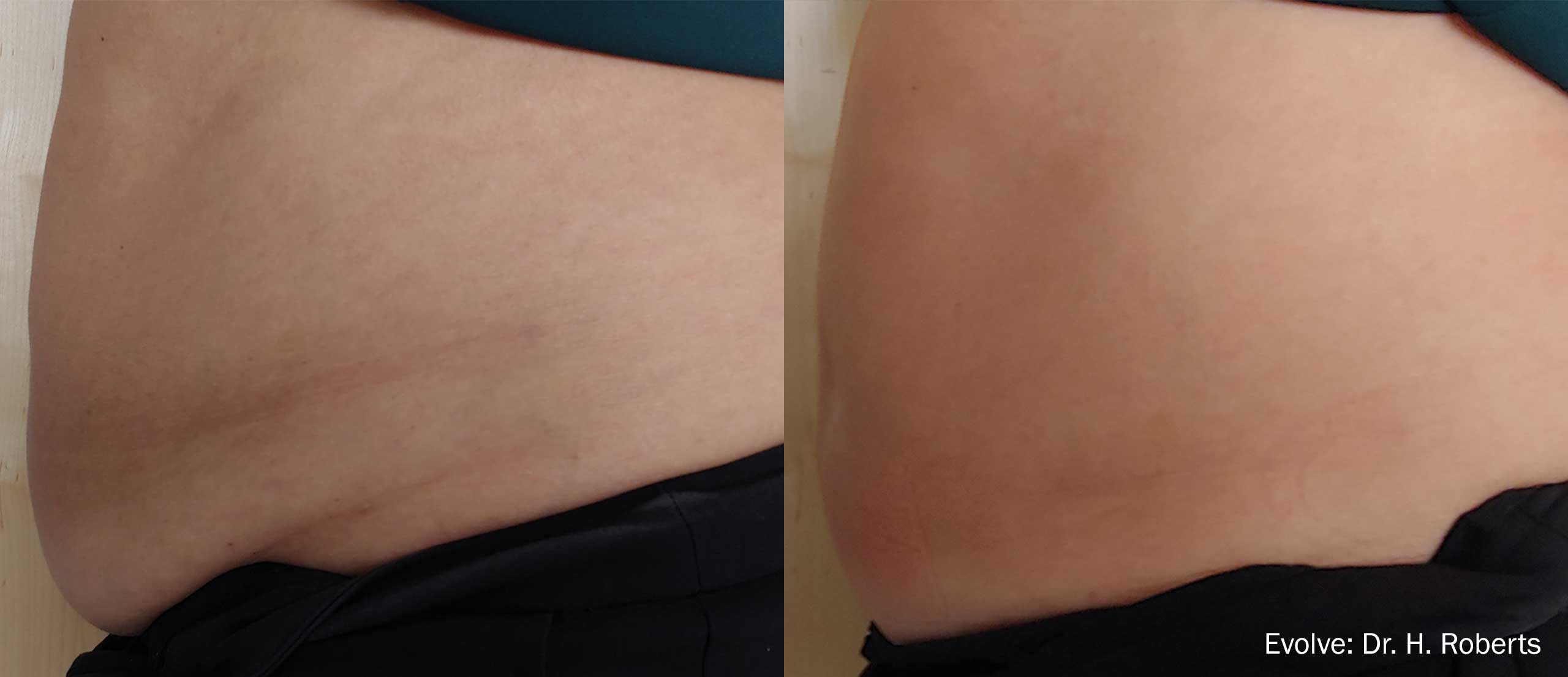 Evolve Before and After Slimmer Waist