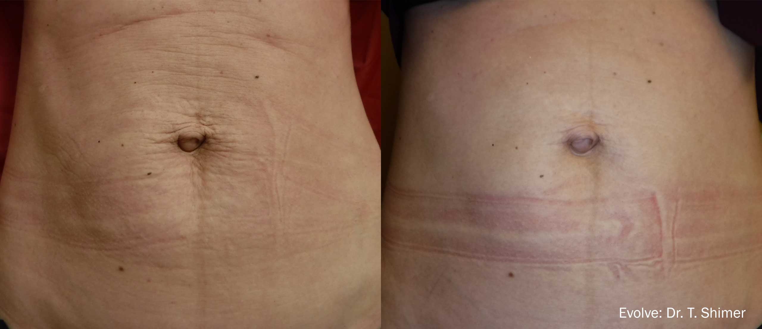 Evolve-Before-and-After-Tighten-Loose-Stomach-Skin