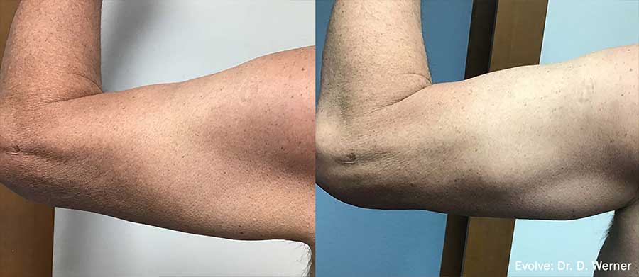 Evolve-Before-and-After-Toned-Arms