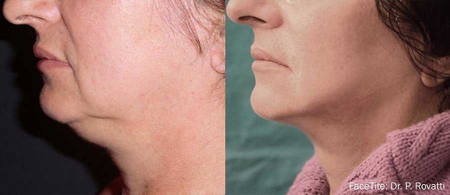 FaceTite-Before-and-After-Chin-Lift