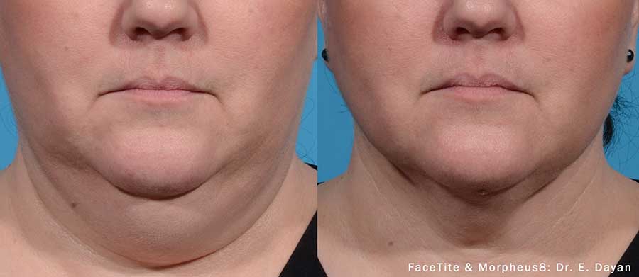 FaceTite-Before-and-After-Chin-Lipo-Alternative