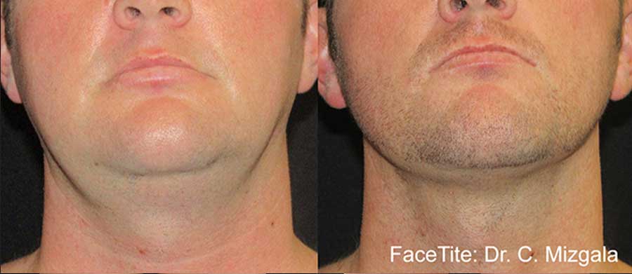FaceTite-Before-and-After---Double-Chin