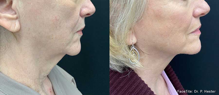 FaceTite-Before-and-After--Non-Surcial-Facelift-Alternative
