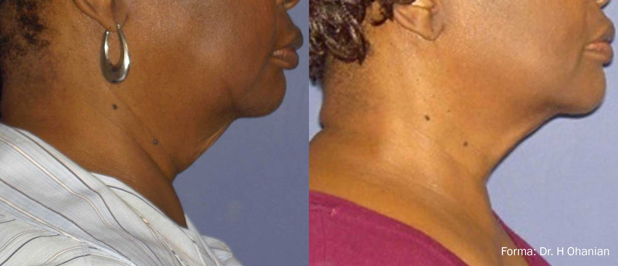 Forma Before and After Double Chin