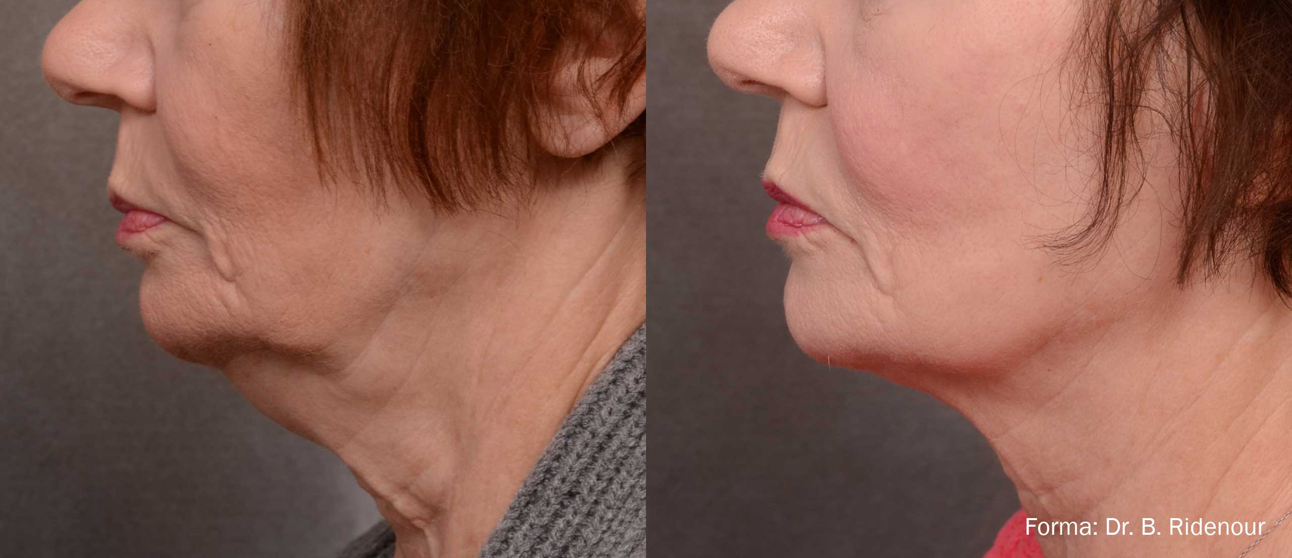 Forma Before and After Jowls