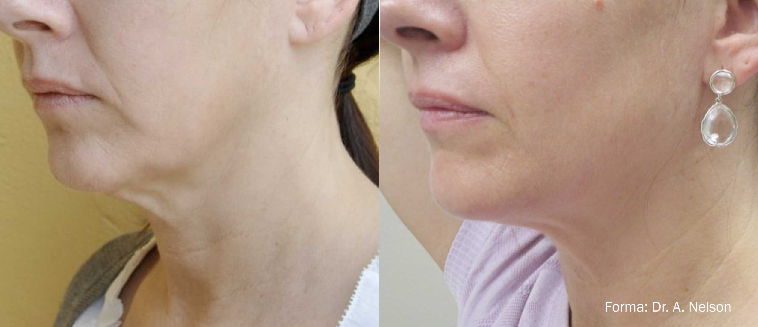 Forma Before and After Neck
