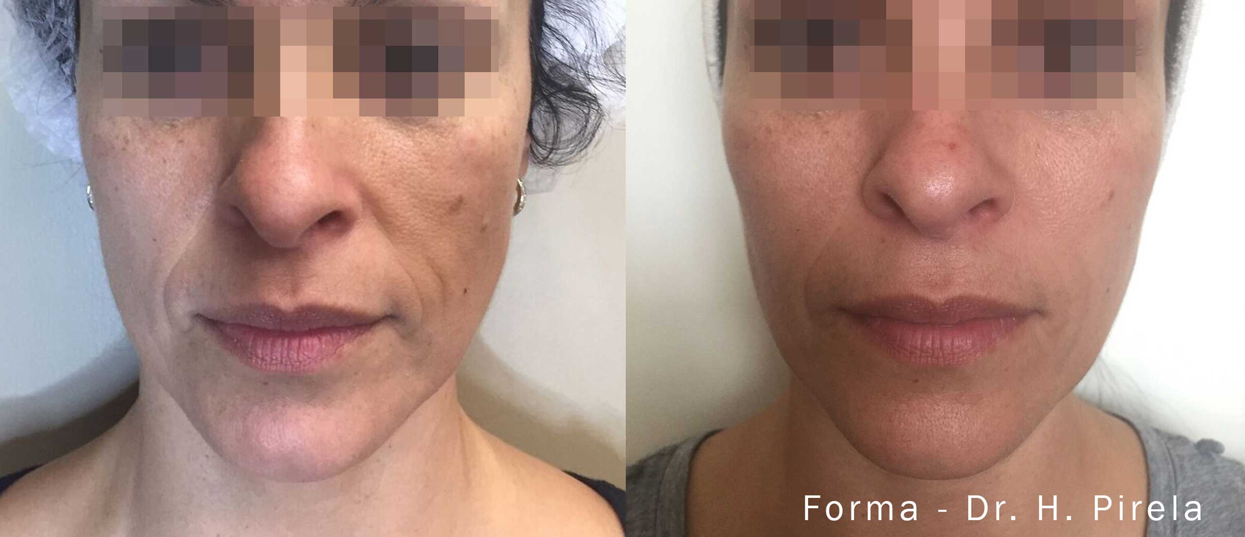 Forma Before and After Smile Lines