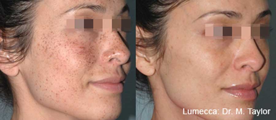 Lumecca-Before-and-After-Freckles