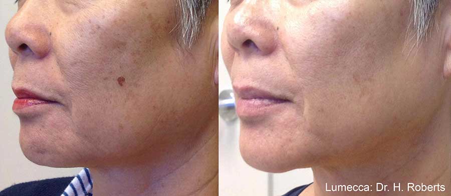 Lumecca-Before-and-After-Hyperpigmentation-Dark-Spots