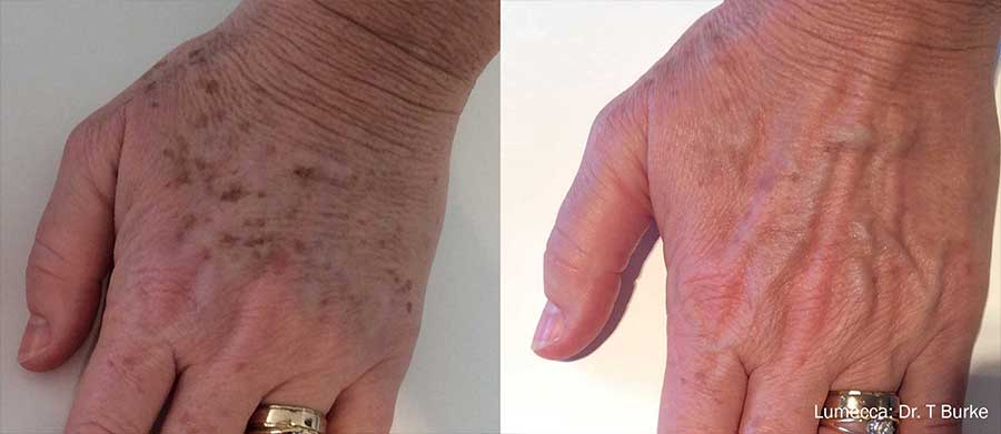 Before and after image