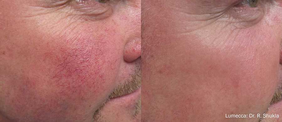 Lumecca-Before-and-After-Redness