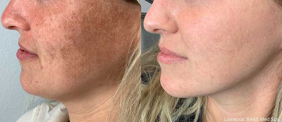 Lumecca-Before-and-After-Sun-Damage