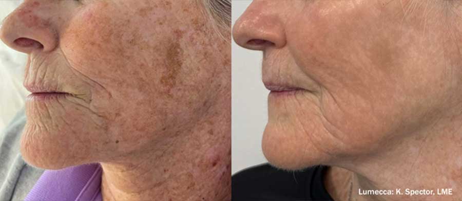 Lumecca-Before-and-After-Sunspots