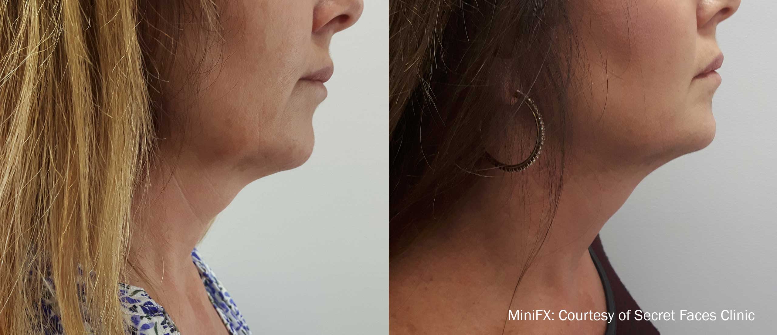MiniFX Before and After Neck and Jawline